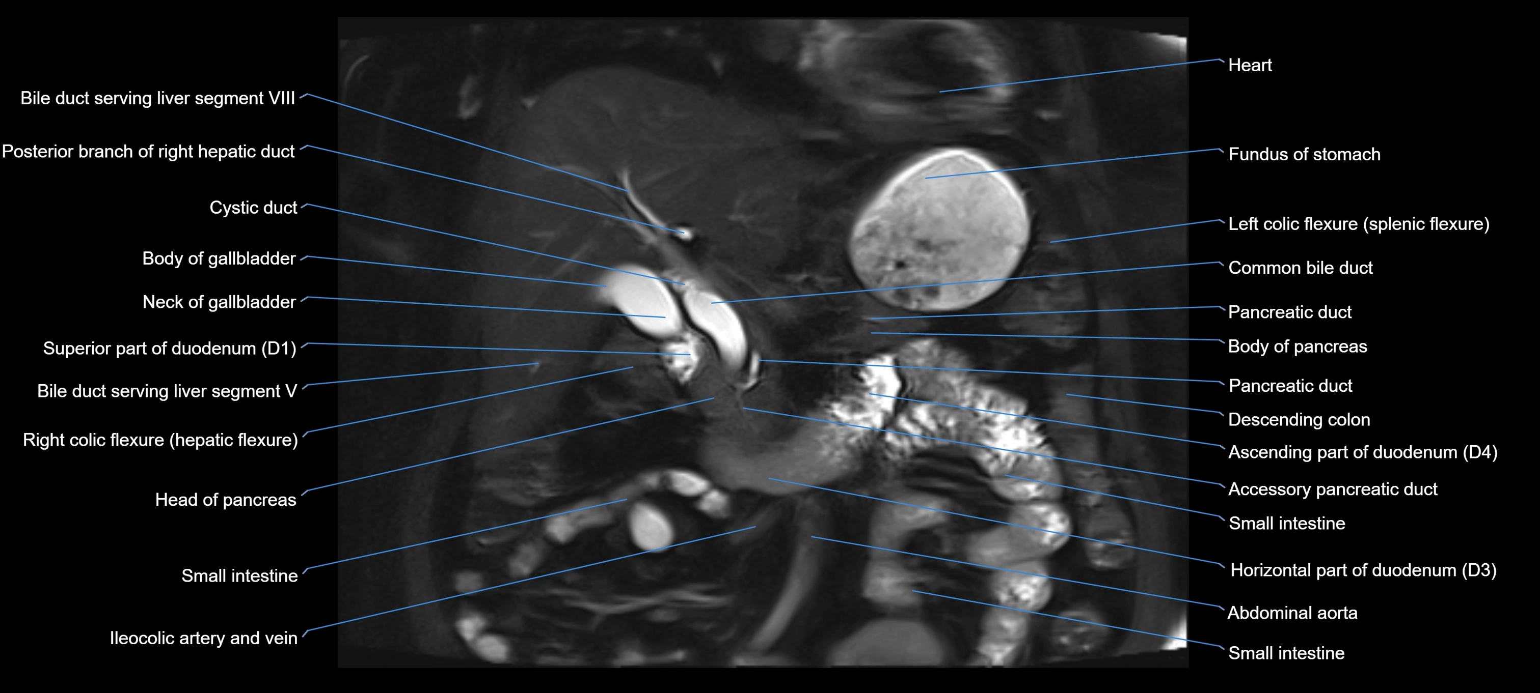 MRI MRCP coronal cross sectional 3T radiology  image-img-00001-00011.webp